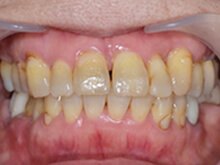 正面から見た状態です。簡易的な矯正治療も同時に実施したため、歯並びもきれいになっています。