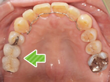 上あごの写真です。奥歯にインプラントを実施し、歯が2本入りました。