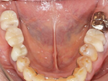 下あごの写真です、むし歯治療と簡易的な矯正治療を実施し、歯並びの改善もしました。