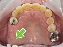 上あごの歯の状態です。奥歯が2本ない状態になっていました。