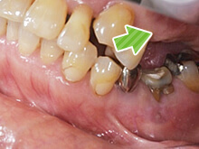 歯をかみ合わせた状態の右上の奥歯の写真です。