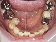 下の歯の状態です。歯並びが悪く歯が磨きにくいため、むし歯になりやすい状態になっていました。