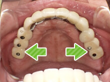 上あごは全てインプラントを治療を実施しました。歯の上に穴があるように見えますが、このあと穴をふさいできれいにしました。