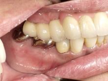 歯をかんだ状態の写真です。