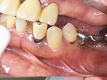 歯をかんだ状態の写真です。